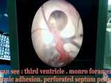هیدروسفالی در دختر ۱۵ ساله به دنبال کیست داخل بطنی