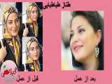 تصاویر قبل و بعد از عمل زیبایی بازیگران ایرانی