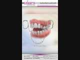 دستگاه عادت شکن | کلینیک دندانپزشکی کانسپتا 