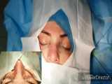 جراحی بینی شکسته با انحراف شدید-دکترراستا ۰۹۳۳۷۱۷۴۸۰۴