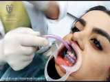 بلیچینگ یا سفید کردن دندان با استفاده از لیزر در اصفهان دکتر میرلوحی