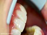 بیدآپ و ونیر کامپوزیت دندان ها با تخریب شدید در اصفهان توسط دکتر محمد عاطفت