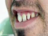 ونیر کامپوزیت و بستن دیاست های دندانی در اصفهان توسط دکتر محمد عاطفت
