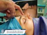 عمل بینی استخوانی توسط دکتر امید ابراهیمی بهترین جراح بینی استخوانی