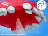ارتودنسی ثابت جهت منظم کردن دندان ها
