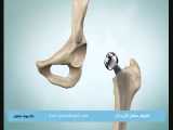 آرتروپلاستی مفصل ران چیست 