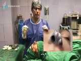 فیلم جراحی بینی با انحراف شدید 