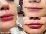 تزریق ژل به لب‌ها