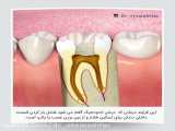 عصب کشی دندان چگونه انجام می گیرد؟ نحوه پرکردن دندان. درمان ریشه دندان