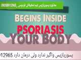 پسوریازیس ناخن و سر