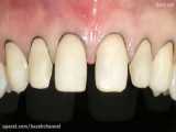 کارهای مقدماتی در دندانپزشکی زیبایی ترمیمی