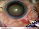 جراحی آب مروارید چشم یا کاتاراکت