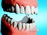 فيديو ابتسامة هوليود | ترميم الاسنان الامامية | علاج الاسنان المكسورة