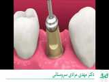 مراحل کامل کاشت دندان یا ایمپلنت