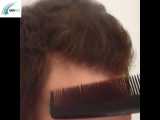 آموزش کاشت مو به روش FIT- مومیس مشاور و مرجع تخصصی مو 