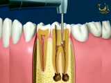 فيديو علاج العصب الاسنان و حشو الجذور الاسنان | طب الاسنان في ايران  |  طب توب