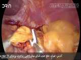 فیلم عمل جراحی لاپاراسکوپی آشالازی مری | دکتر داود نریمان زاده