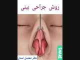 عمل بینی آرایشی
