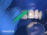 ترمیم پوسیدگی دندان-دکترمجیدقیاسی-دندانپزشک زیبایی مشهد 