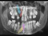تصحیح موقعیت دندانها در یک بیمار کلیدوکرانیال | دکتر همت پور 