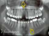 ارتودنسی با کشیدن دندان | دکتر سیامک همت پور 