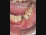 هدایت رویشی دندان نیش پایین | دکتر سیامک همت پور 