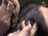 فیلم مراحل میکرواسکالپ| میکروپیگمنتیشن موی سر چیست؟ 