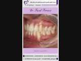 ارتودنسی ثابت همراه با کشیدن دندان | دکتر فیروزی 