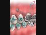 روش های درمانی ارتودنسی