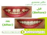 کاشت تخصصی دندان (ایمپلنت)
