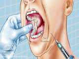 بلوک عصبی آلوئولار دندانی
