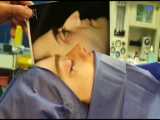 جراحی انحراف شدید بینی توسط بهترین جراح بینی دکتر امید ابراهیمی