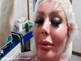 لیفت صورت با استفاده از نخ
