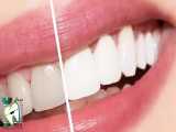 بلیچینگ یا سفیدکردن دندان چیست؟ | کلینیک دندانپزشکی ایده آل 