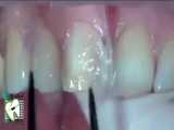 مراحل درمان زیبایی کامپوزیت ونیر | کلینیک دندانپزشکی ایده آل 