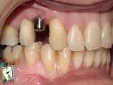اول ایمپلنت یا ارتودنسی؟ | کلینیک دندانپزشکی ایده آل 