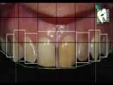 اصلاح طرح لبخند با استفاده از لمینت و لیفت لثه | کلینیک دندانپزشکی ایده آل 