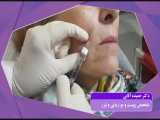 فیلم تزریق ژل ضد چین و چروک