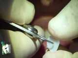 اصلاح طرح لبخند با استفاده از لمینت سرامیکی | کلینیک دندانپزشکی ایده آل 