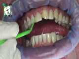 اصلاح طرح لبخند با لمینت سرامیکی | کلینیک دندانپزشکی ایده آل 