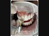 پالیش کامپوزیت ونیر | کلینیک دندانپزشکی ایده آل 