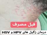 ویدیو درمان بیماری زگیل تناسلی