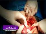 فیلم انجام عمل جراحی هسترکتومی