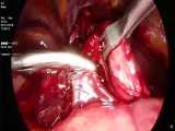 عمل جراحی تنگی حالب distal uretrouretrostomy توسط دکتر امیر افیونی