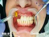 کاشت ایمپلنت دندان و بریج دندان