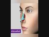 نوک بینی برجسته در جراحی زیبایی بینی 