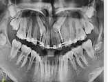 دندان نیش نهفته و راهکار درمان آن | دکتر فیروزی 