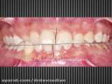 قبل و بعد ارتودنسی نامرتبی دندانی و کراس بایت | دکتر داوودیان