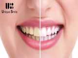 اصلاح رنگ دندان | دکتر لیلا عطایی 