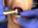 خارج کردن براکت های ارتودنسی | دندانستان 